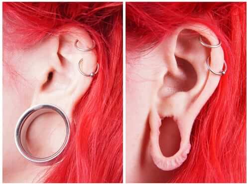 Earlobe Gauge Repair Dr Matthew Conrad