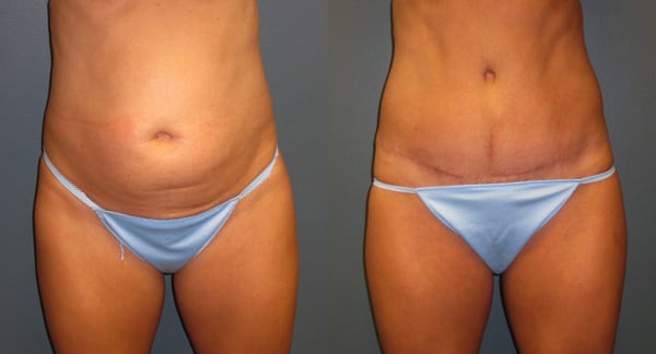 Which Type of Tummy Tuck Is Best for Me? - Dr. Matthew Conrad