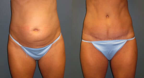 Which Type of Tummy Tuck Is Best for Me? - Dr. Matthew Conrad