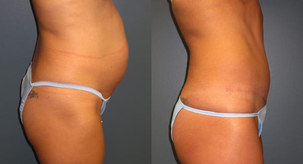 Before and After Abdominoplasty Patient 04 Gallery, Wichita, KS