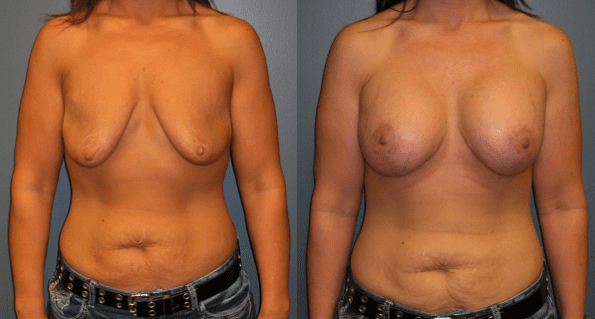 Breast Augmentation with Lift Before and After Photos