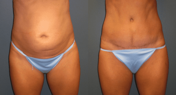 Tummy Tuck Before and After Photos