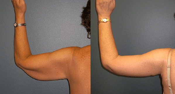 Arm Lift Before and After Photos