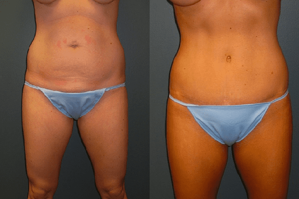 Tummy Tuck Before and After Photos