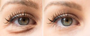 Eye bags before and after cosmetic treatment