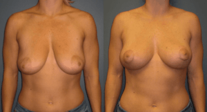 Conrad Breast Lift Patient Before and After