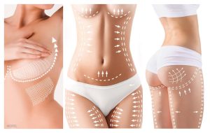 Cosmetic body surgeries.