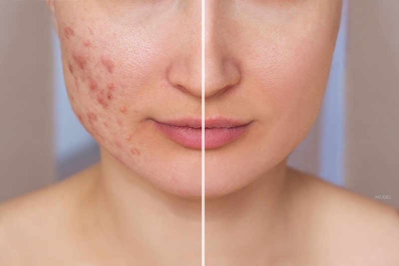A woman's face before and after acne scar treatment.