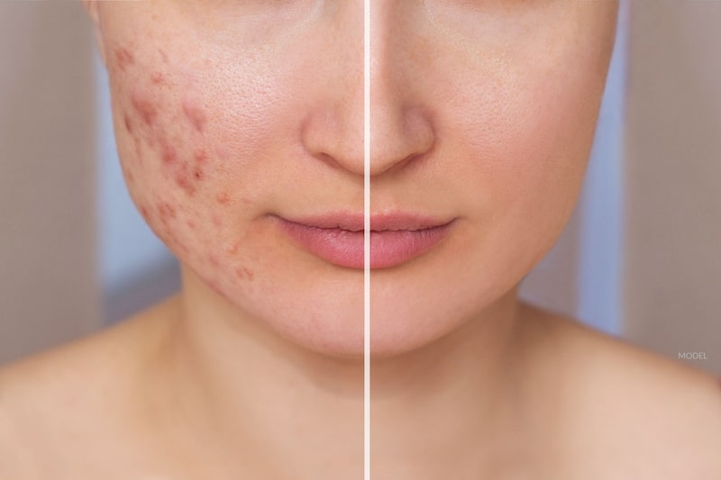 Treatment For Acne Scars