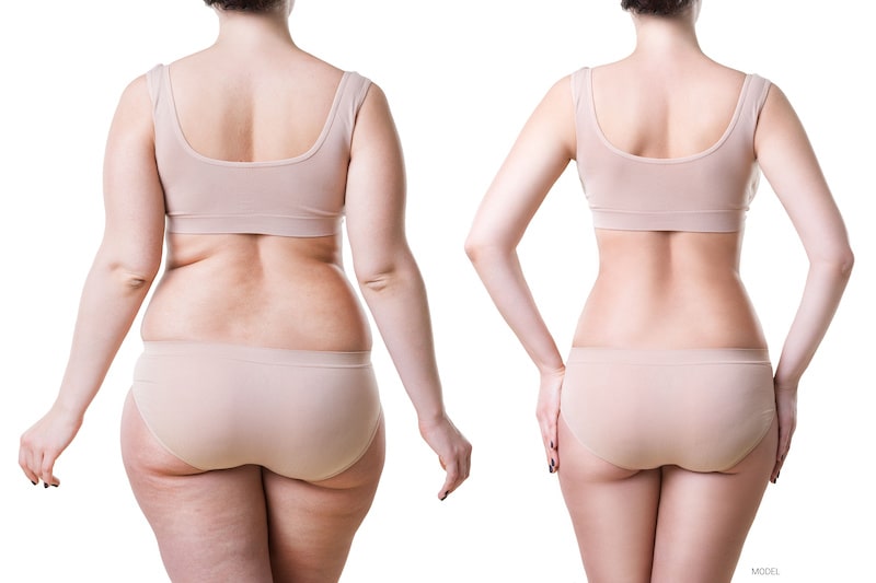 A woman before and after liposuction and body contouring.