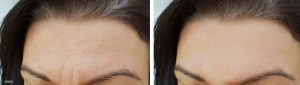 A before and after photo of a forehead lift.