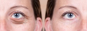 A before and after photo of cosmetic eyelid surgery.