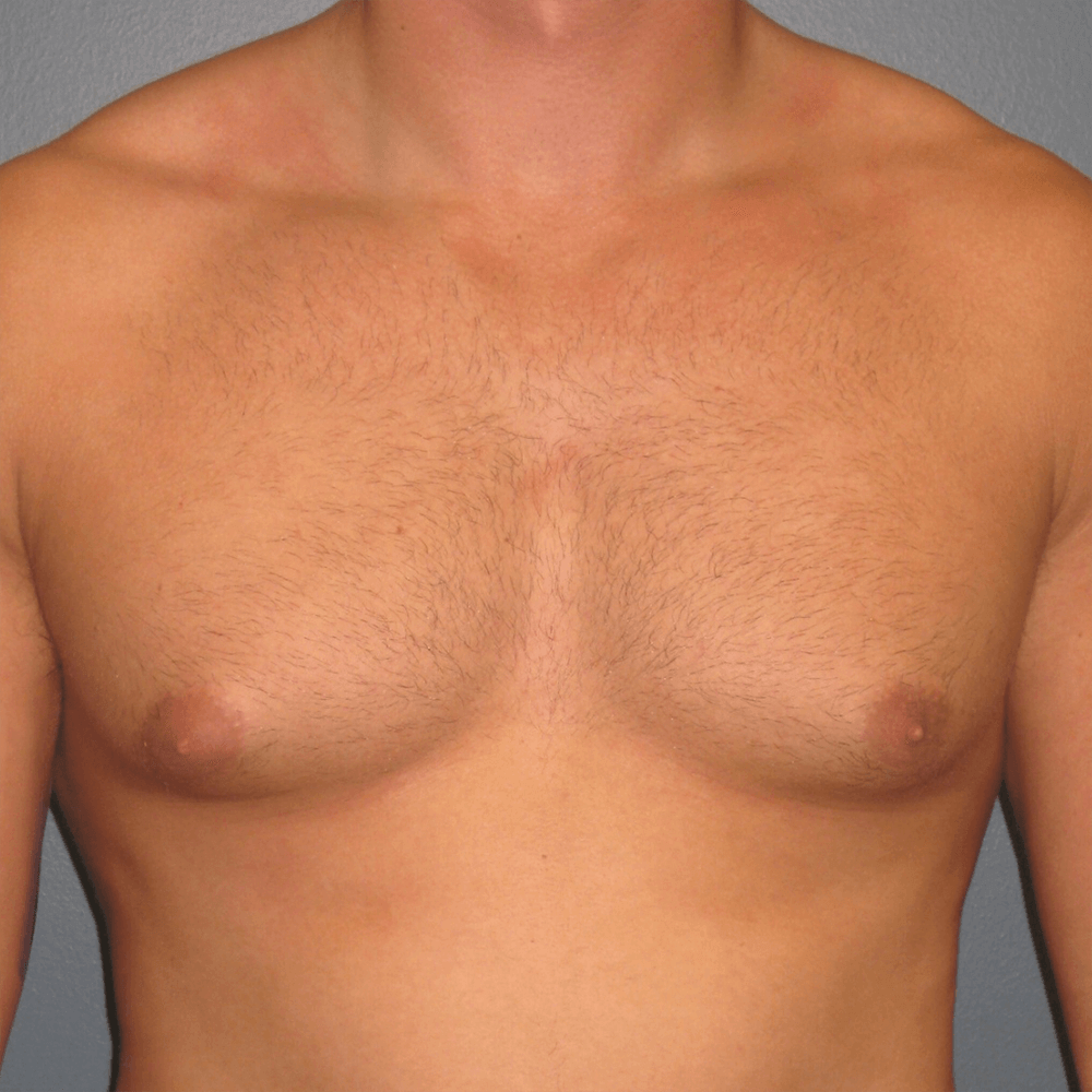 Case--4818 | Before Gynecomastia 1