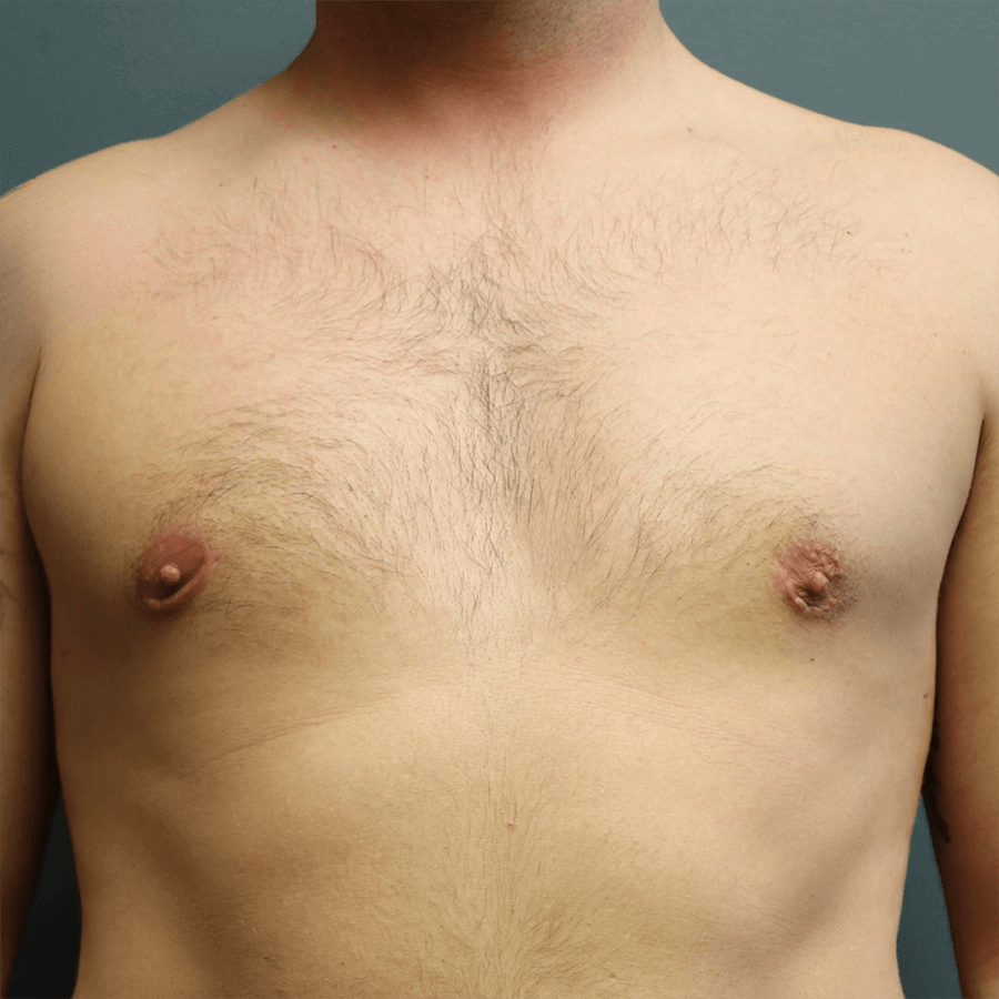 Case--3192 | After Gynecomastia 1
