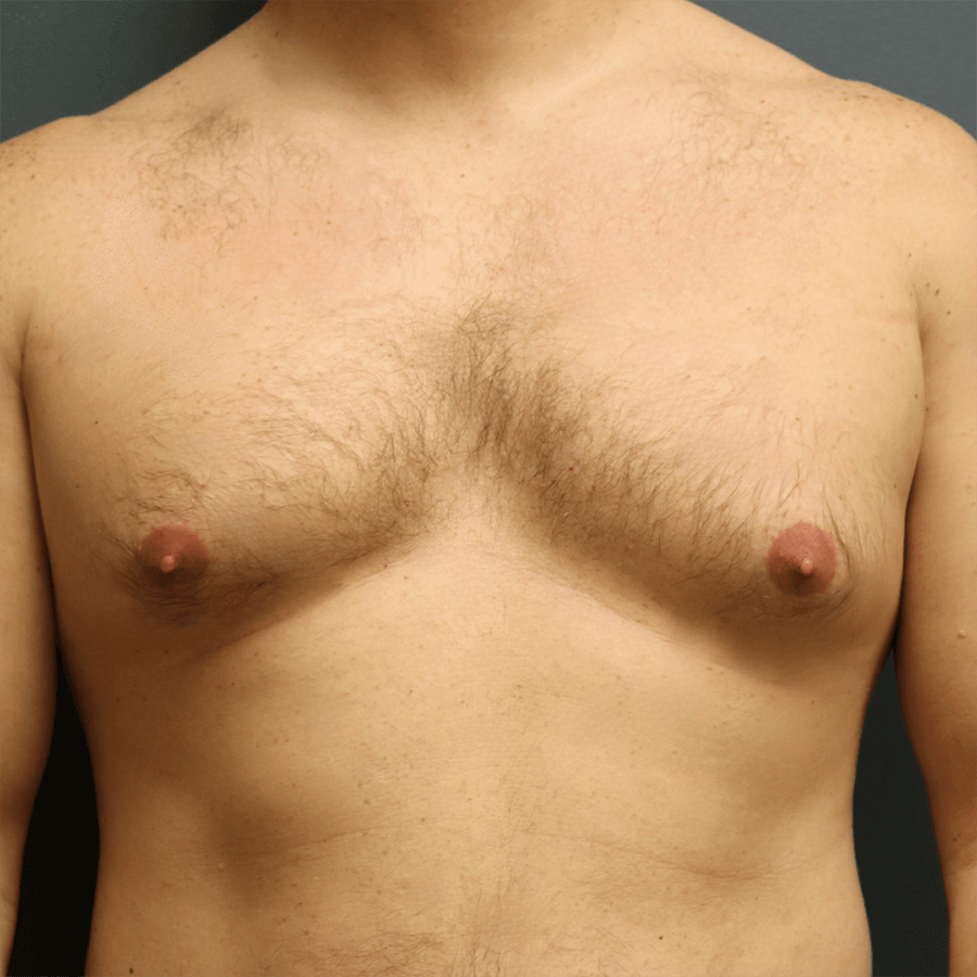 Case--5045 | Before Gynecomastia 1