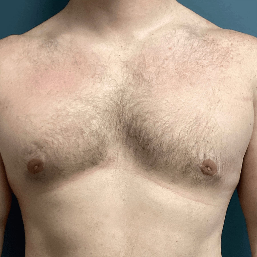 Case--5045 | After Gynecomastia 1