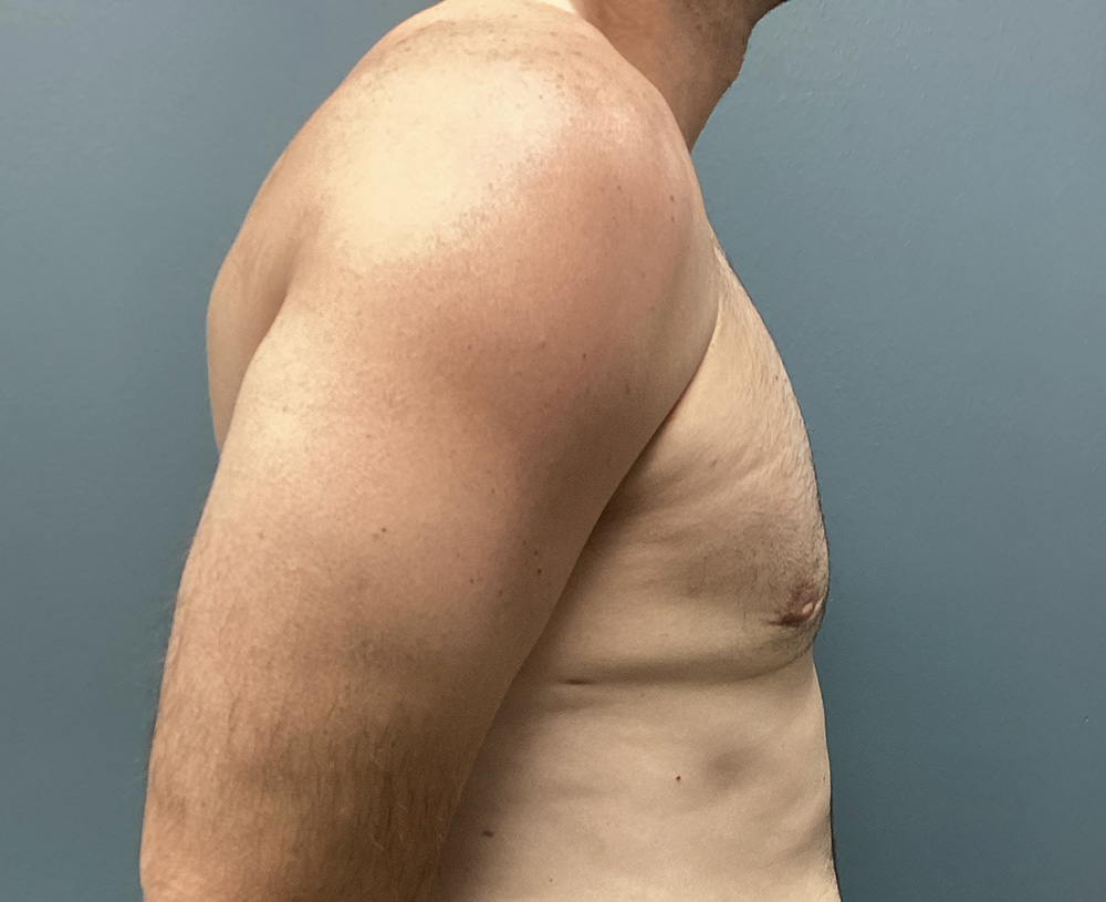 Case--4461 | After Gynecomastia 1