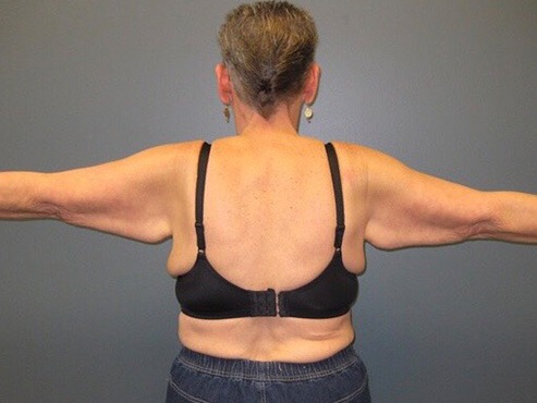 Arm-Lift-Patient-03 | Before Arm Lift 1