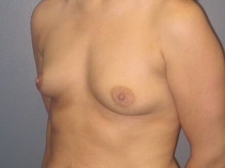 Breast-Augmentation-Patient-14 | Before Breast Augmentation 1