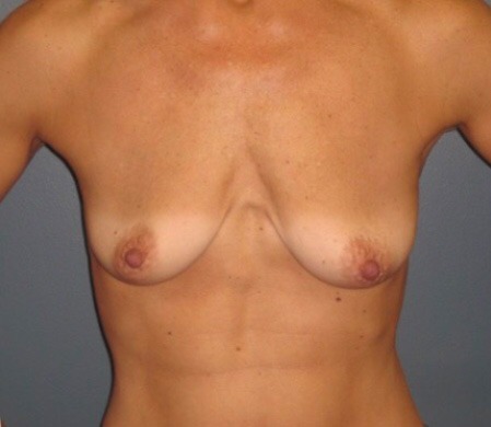 Breast-Augmentation-with-Lift-Patient-07 | Before Breast Augmentation and Mastopexy 1