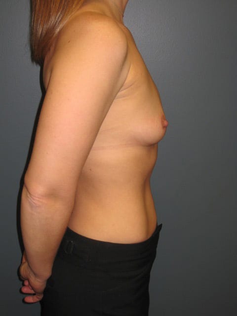 Breast-Augmentation-Patient-09 | Before Breast Augmentation 2