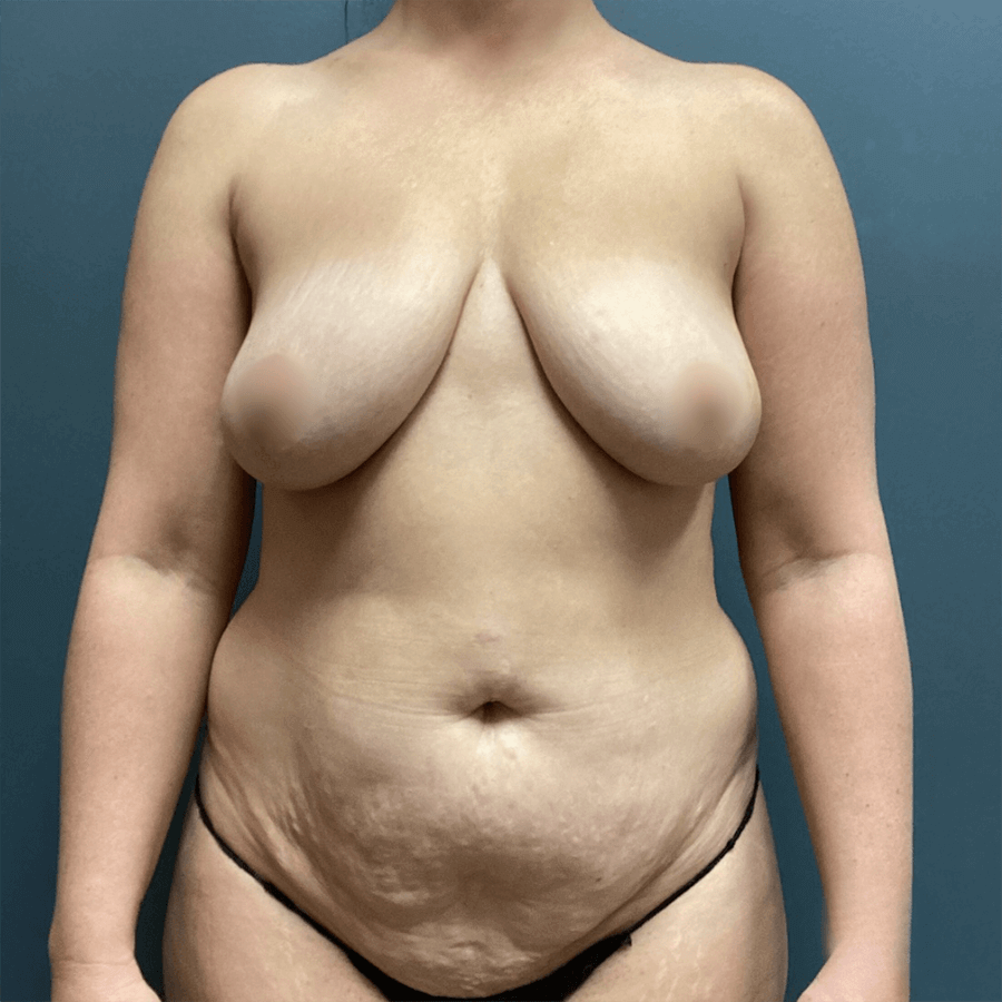 Case--8497 | Before Mommy Makeover 1