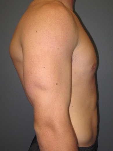 Gynecomastia-Patient-01 | After Gynecomastia 1