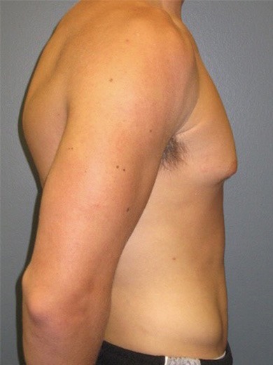 Gynecomastia-Patient-01 | Before Gynecomastia 1