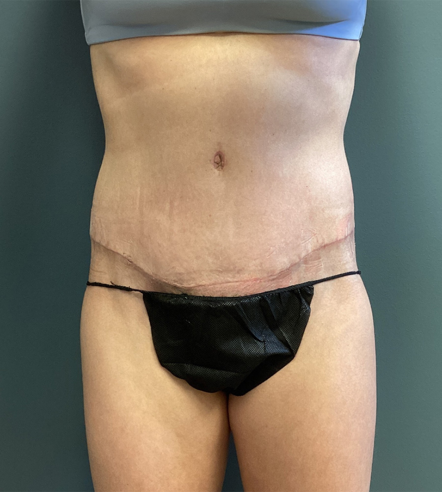 Abdominoplasty-Patient-05 | After Abdominoplasty 1