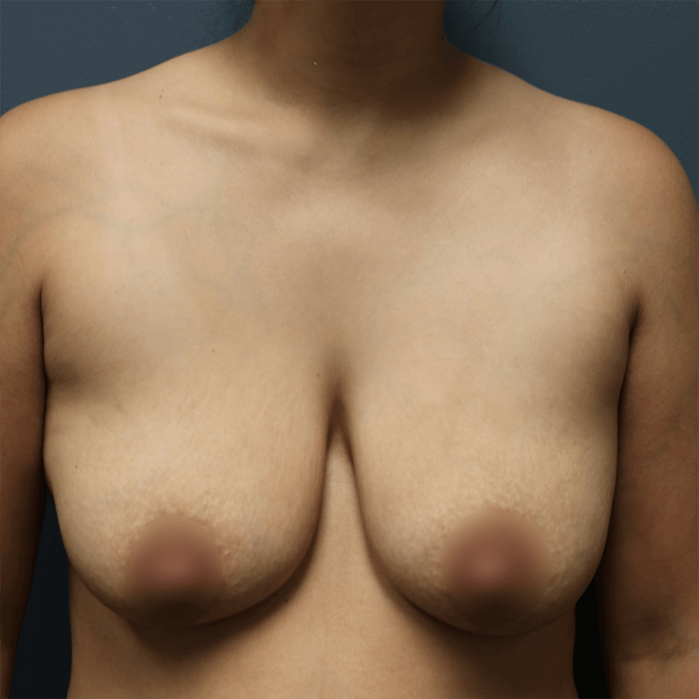 Case--2267 | Before Breast Augmentation and Mastopexy 1