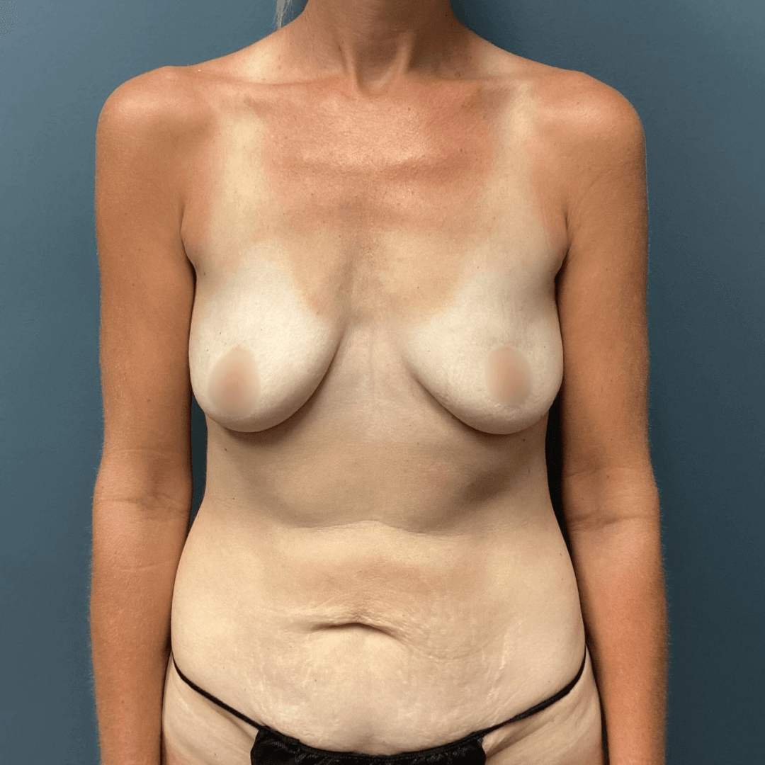 Case--2450 | Before Mommy Makeover 1