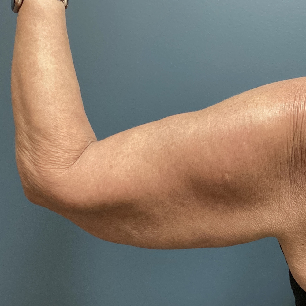 Arm-Lift-Patient-05 | Before Arm Lift 2