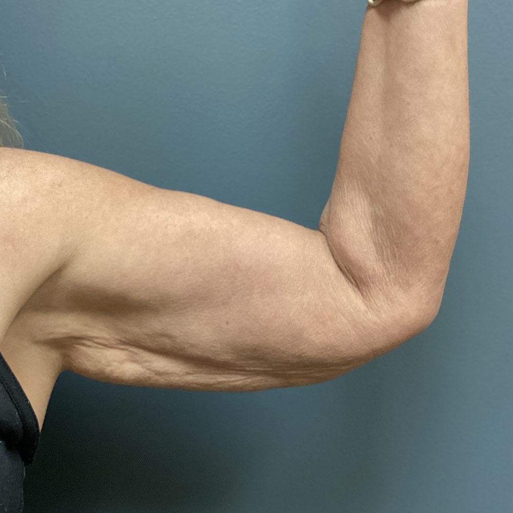 Arm-Lift-Patient-05 | Before Arm Lift 1