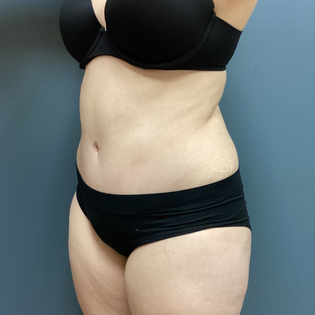 Abdominoplasty-Patient-06 | After Abdominoplasty 1