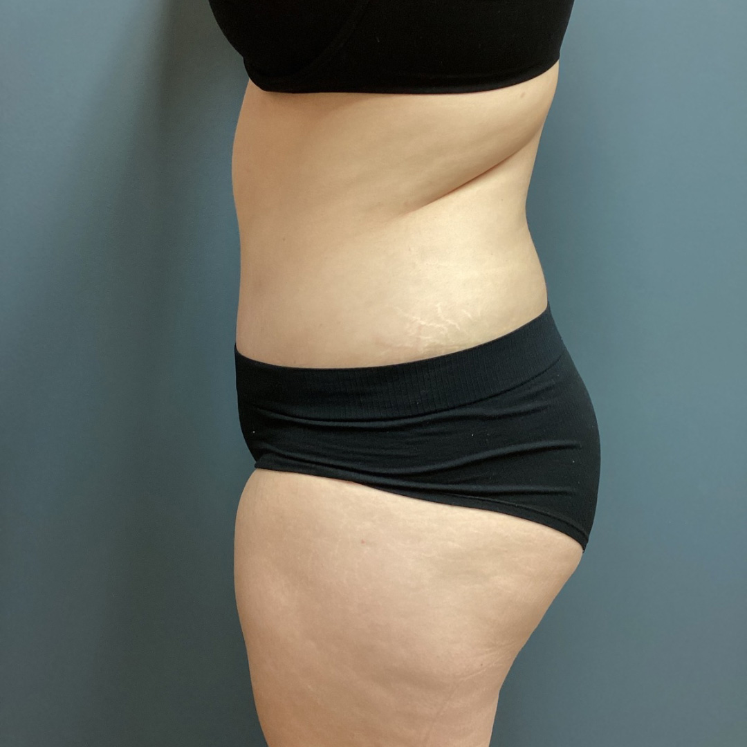 Abdominoplasty-Patient-06 | After Abdominoplasty 2