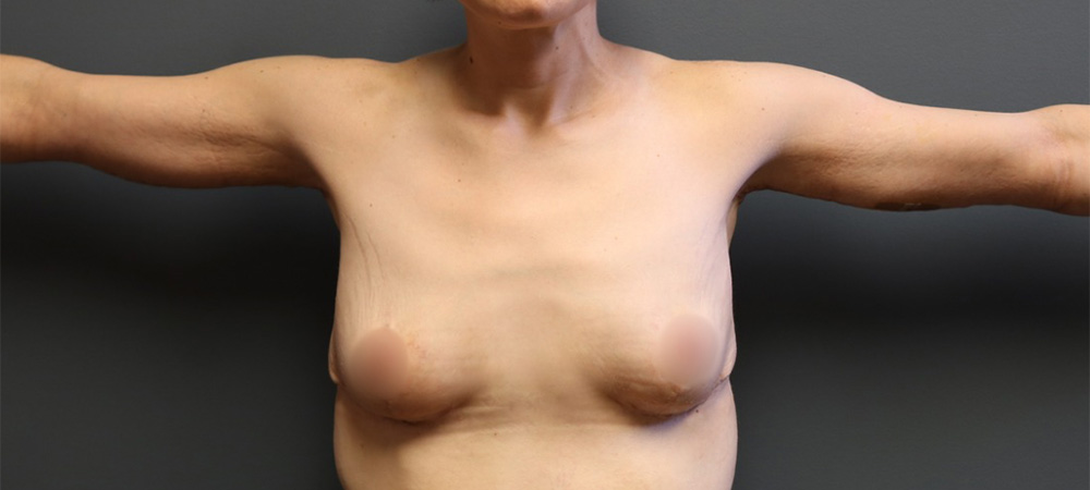 Arm-Lift-Patient-06 | After Arm Lift 1