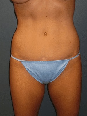 Abdominoplasty-Patient-01 | After Abdominoplasty 1