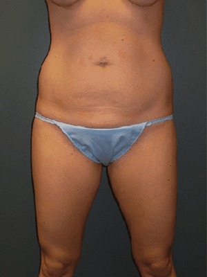 Abdominoplasty-Patient-01 | Before Abdominoplasty 1