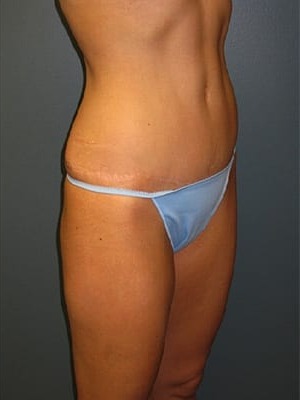 Abdominoplasty-Patient-01 | After Abdominoplasty 2