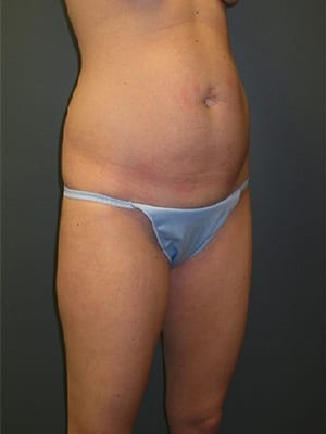 Abdominoplasty-Patient-01 | Before Abdominoplasty 2