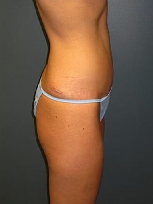 Abdominoplasty-Patient-01 | After Abdominoplasty 3