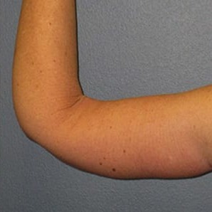 Arm-Lift-Patient-01 | After Arm Lift 3