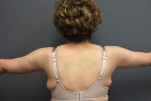 Arm-Lift-Patient-04 | After Arm Lift 2