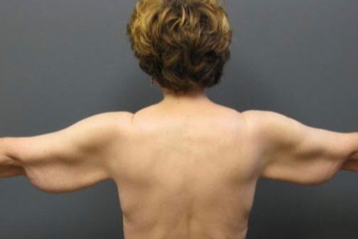 Arm-Lift-Patient-04 | Before Arm Lift 2