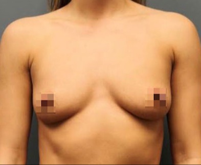 Breast-Augmentation-Patient-21 | Before Breast Augmentation 1