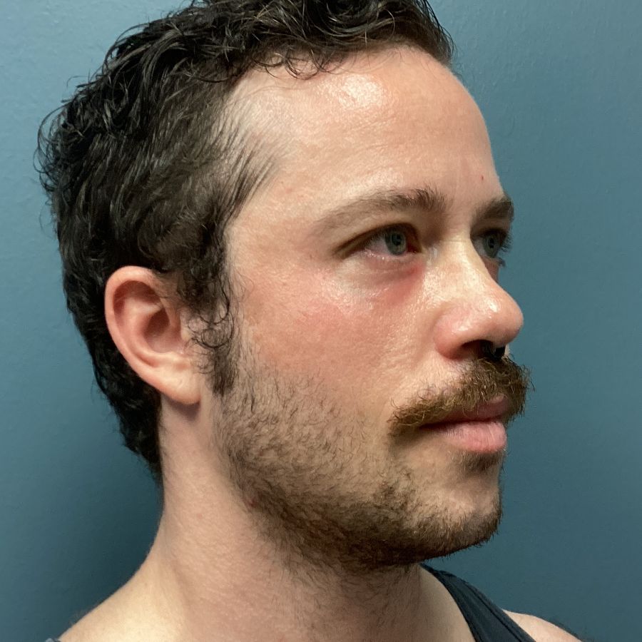 After blepharoplasty procedure oblique