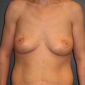Body-Lift-After-Weight-Loss-Patient-01 | After Body Lift After Weight Loss 1