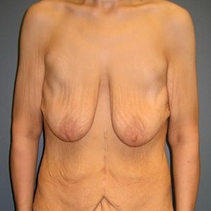 Body-Lift-After-Weight-Loss-Patient-01 | Before Body Lift After Weight Loss 1