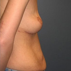 Body-Lift-After-Weight-Loss-Patient-01 | After Body Lift After Weight Loss 2