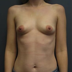 Breast-Augmentation-Patient-04 | Before Breast Augmentation 1